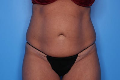 Tummy Tuck Before & After Gallery - Patient 270933 - Image 1
