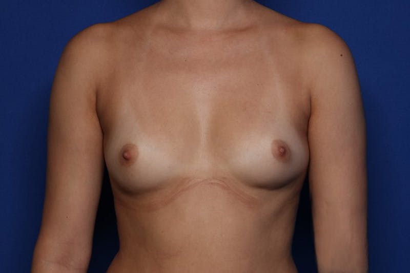Breast Augmentation Before & After Gallery - Patient 193495 - Image 1