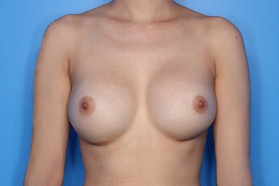 Breast Augmentation Before & After Gallery - Patient 193495 - Image 2