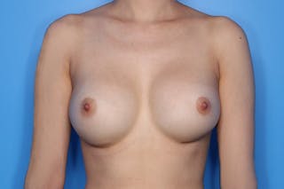 Breast Augmentation Before & After Gallery - Patient 193495 - Image 2