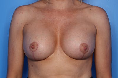 Implant Exchange Before & After Gallery - Patient 878554 - Image 2