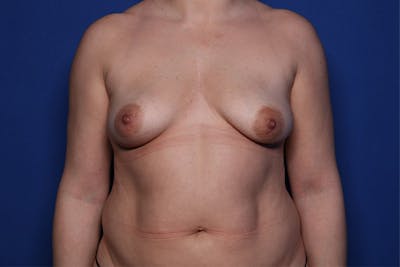 Breast Augmentation Before & After Gallery - Patient 332490 - Image 1
