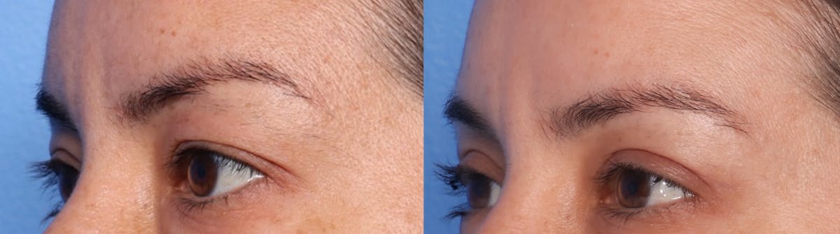 Blepharoplasty Before & After Gallery - Patient 187610 - Image 1