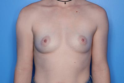 Breast Augmentation Before & After Gallery - Patient 443324 - Image 1