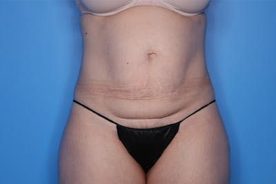 Liposuction Before & After Gallery - Patient 399625 - Image 1