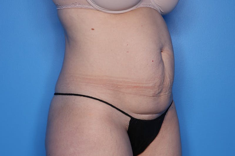 Tummy Tuck Before & After Gallery - Patient 279280 - Image 3