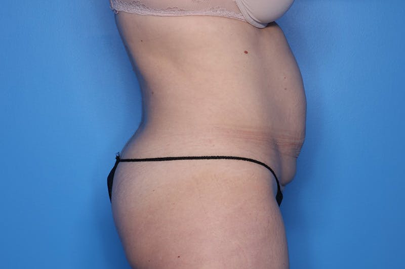 Tummy Tuck Before & After Gallery - Patient 279280 - Image 5