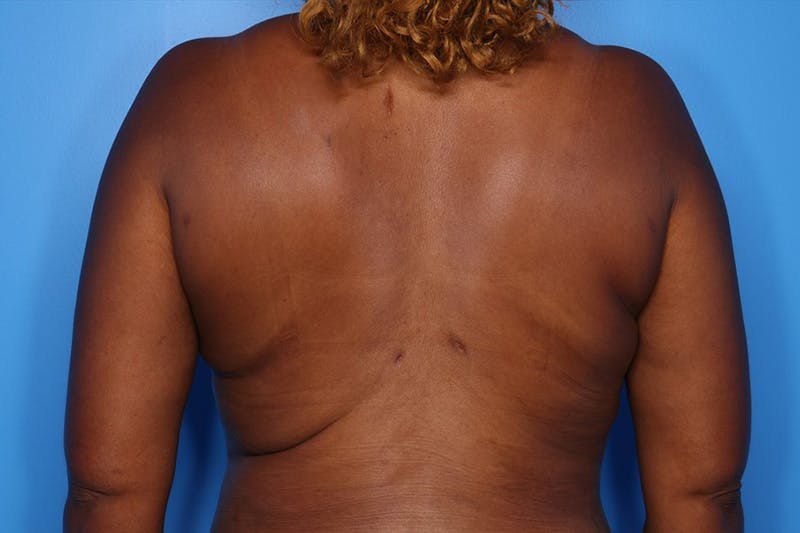 BodyTite™ Before and After Before & After Gallery - Patient 541275 - Image 6