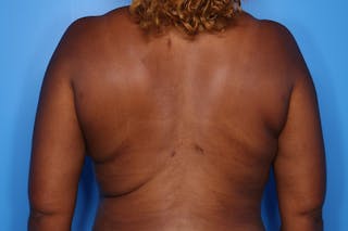 BodyTite™ Before and After Before & After Gallery - Patient 541275 - Image 6