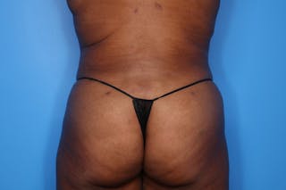 BodyTite™ Before and After Before & After Gallery - Patient 541275 - Image 4