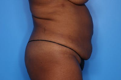 BodyTite™ Before and After Before & After Gallery - Patient 541275 - Image 1