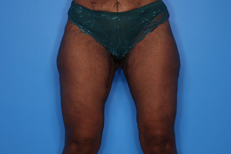 Liposuction Before & After Gallery - Patient 272098 - Image 4