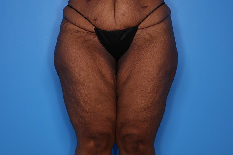 Liposuction Before & After Gallery - Patient 272098 - Image 1