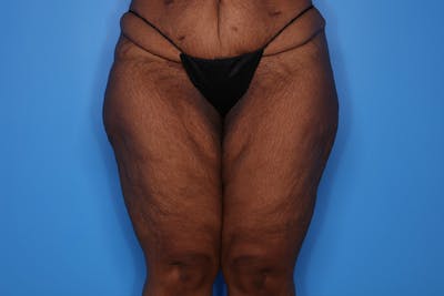 Liposuction Before & After Gallery - Patient 272098 - Image 1