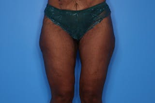 Liposuction Before & After Gallery - Patient 272098 - Image 2