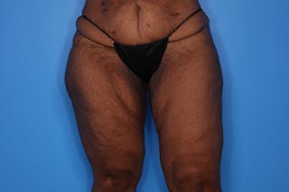 Liposuction Before & After Gallery - Patient 272098 - Image 6