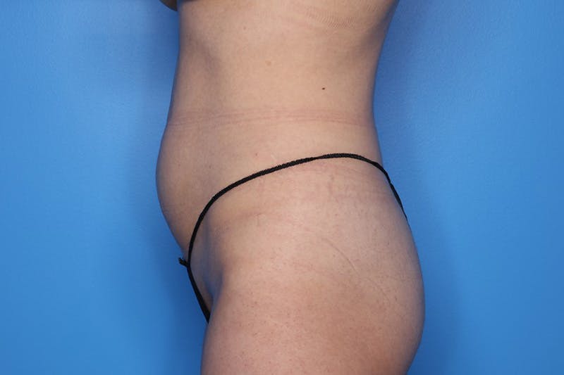 Liposuction Before & After Gallery - Patient 242765 - Image 5