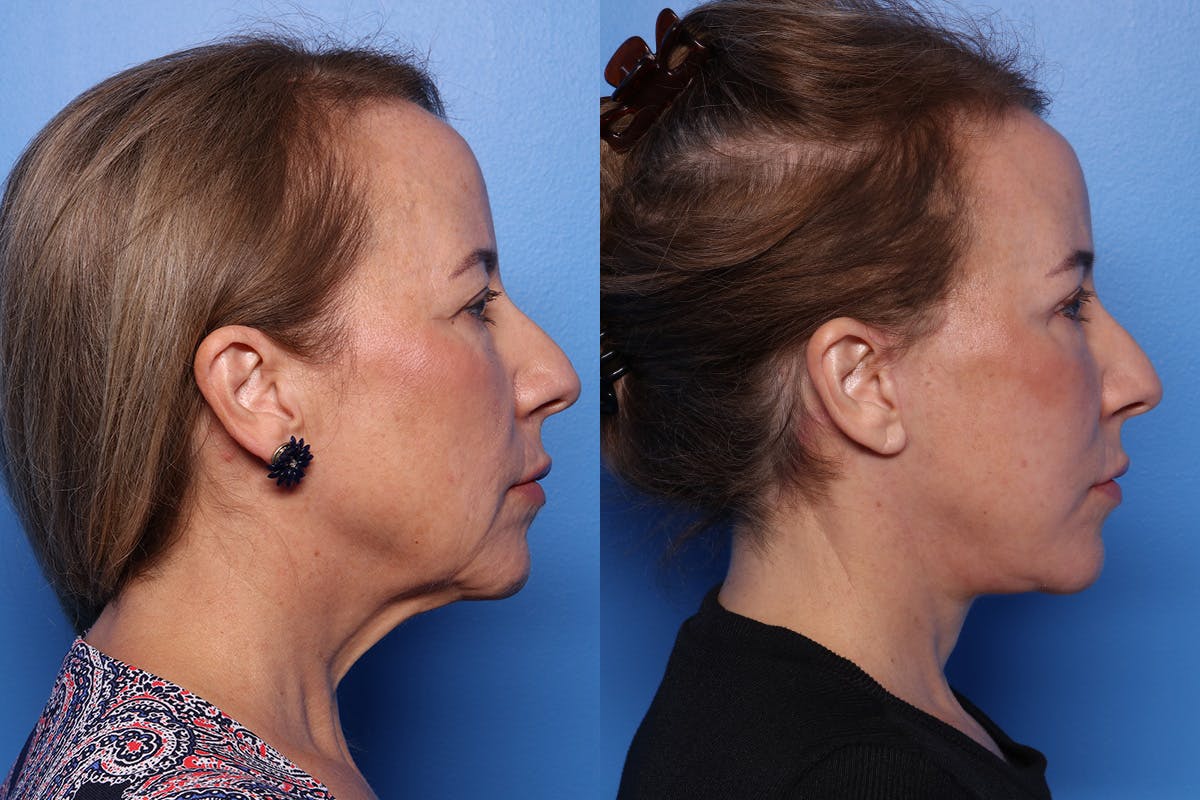 Facelift Before & After Gallery - Patient 110619 - Image 2