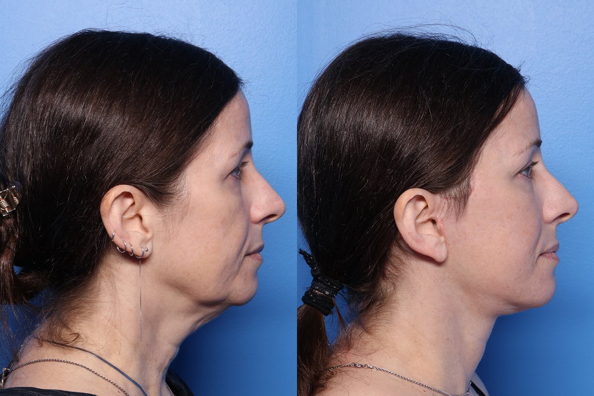 Facelift Before & After Gallery - Patient 167081 - Image 2