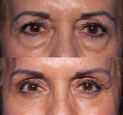 Blepharoplasty Before & After Gallery - Patient 224556 - Image 1