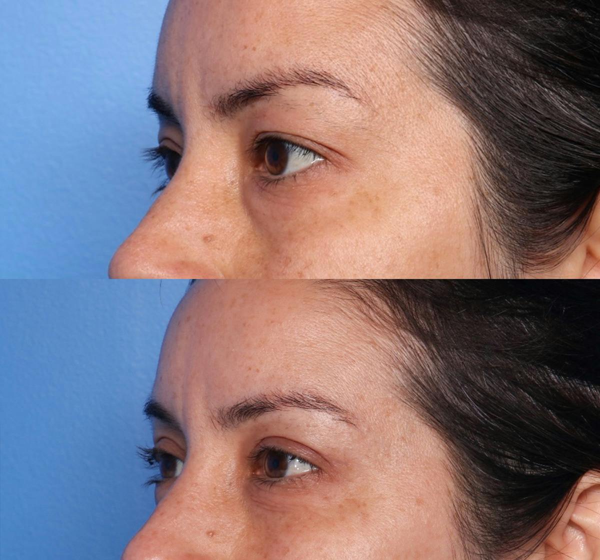 Blepharoplasty Before & After Gallery - Patient 254258 - Image 2