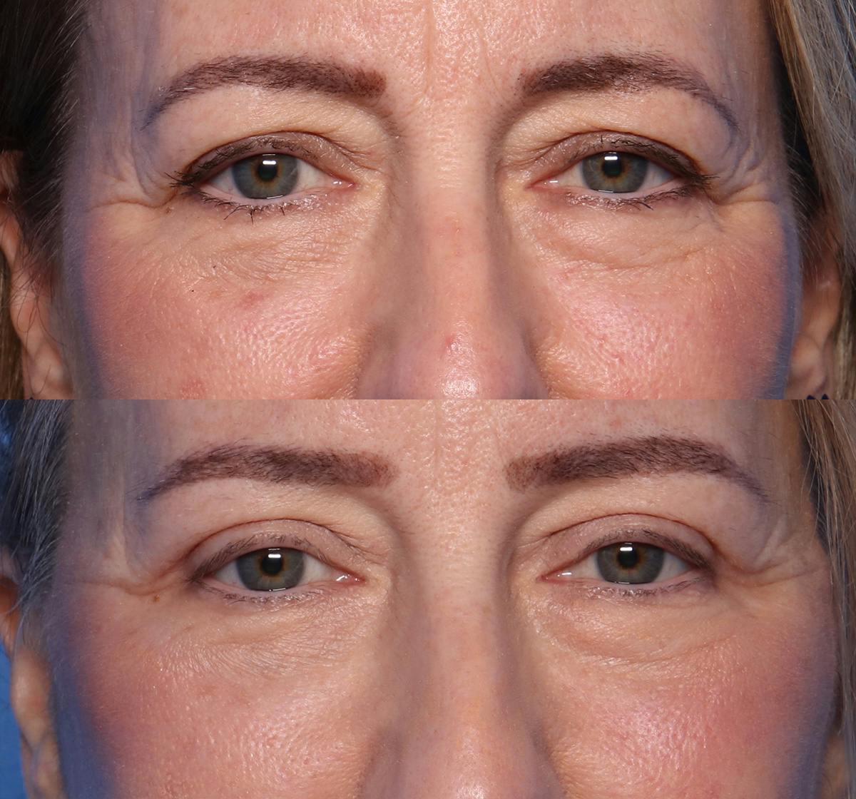 Blepharoplasty Before & After Gallery - Patient 186594 - Image 1