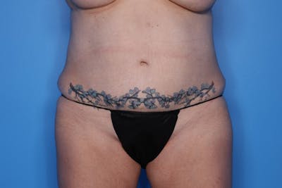 BodyTite™ Before and After Before & After Gallery - Patient 406919 - Image 1