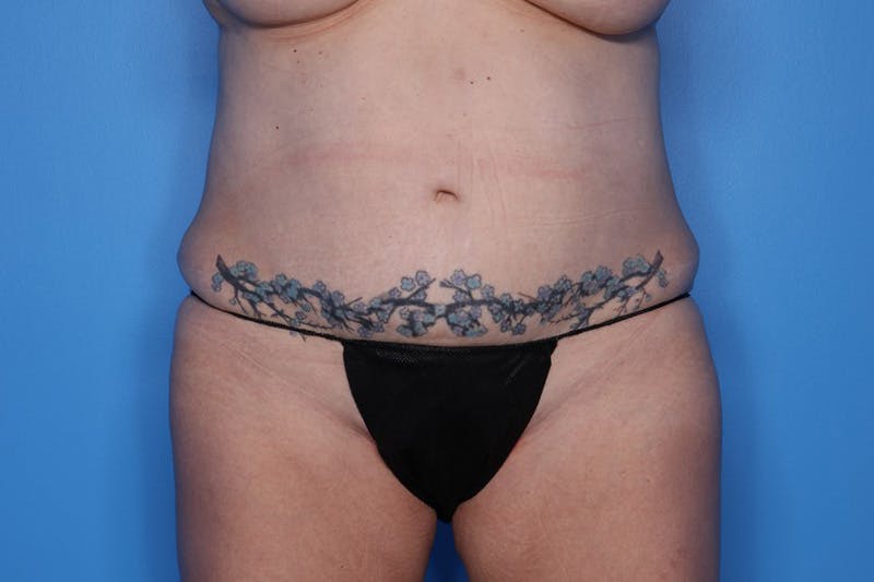 BodyTite™ Before and After Before & After Gallery - Patient 406919 - Image 1