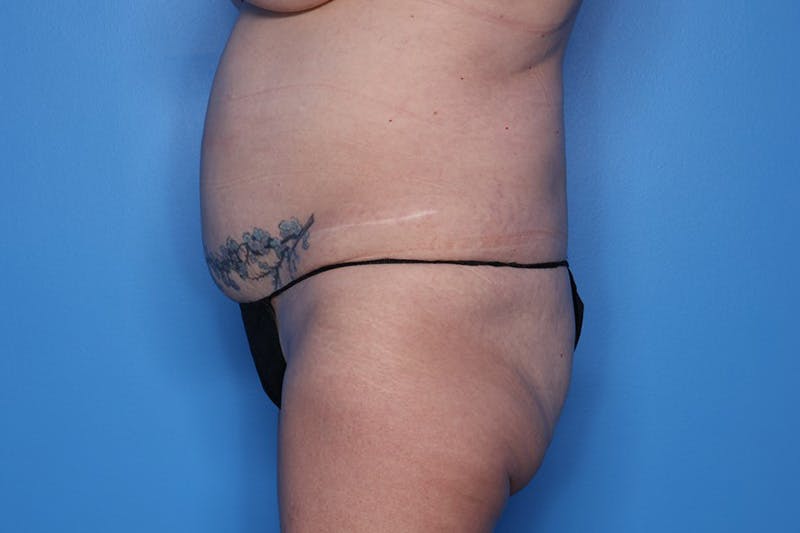 BodyTite™ Before and After Before & After Gallery - Patient 406919 - Image 5