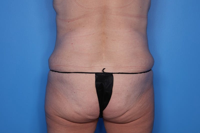 BodyTite™ Before and After Before & After Gallery - Patient 406919 - Image 7
