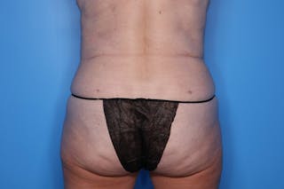 BodyTite™ Before and After Before & After Gallery - Patient 406919 - Image 8