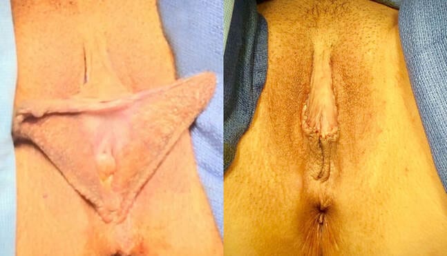 labiaplasty results