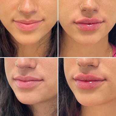 lip filler patient photos