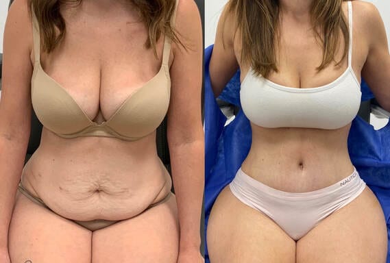 tummy tuck patient beore and after photos