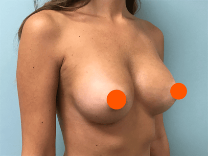 breast augmentation patient