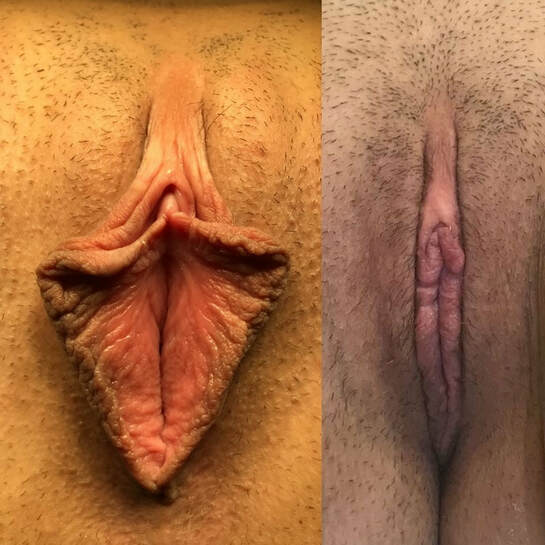 labiaplasty results