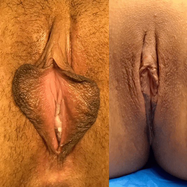 labiaplasty results