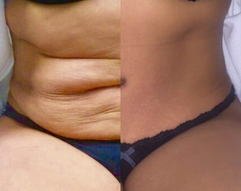 tummy tuck results side by side