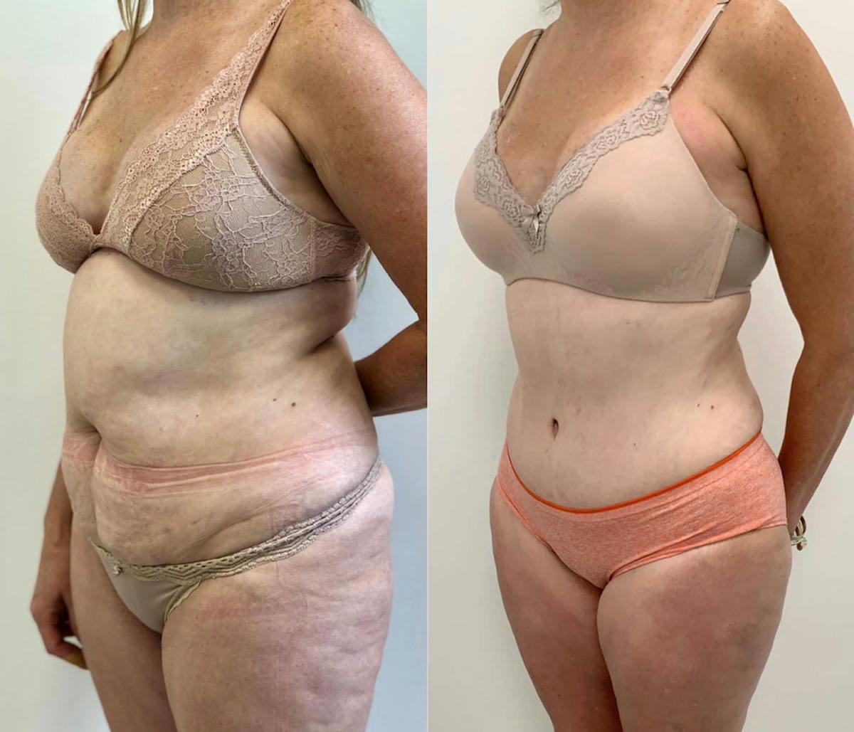 Tummy Tuck Before & After Gallery - Patient 314354 - Image 2