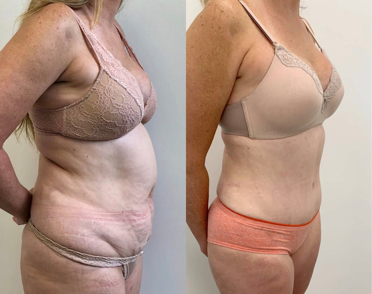 Tummy Tuck Before & After Gallery - Patient 314354 - Image 3