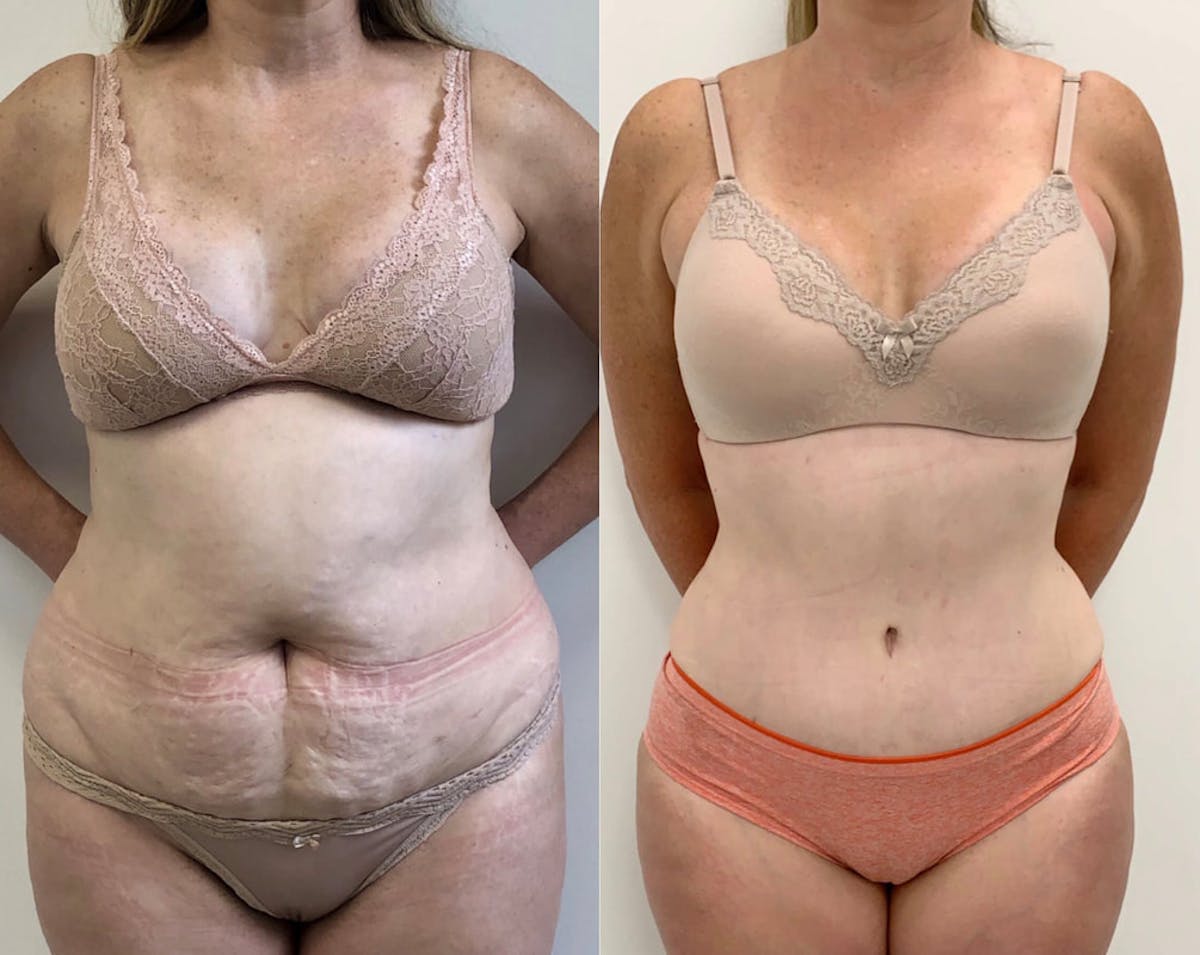 Tummy Tuck Before & After Gallery - Patient 314354 - Image 4