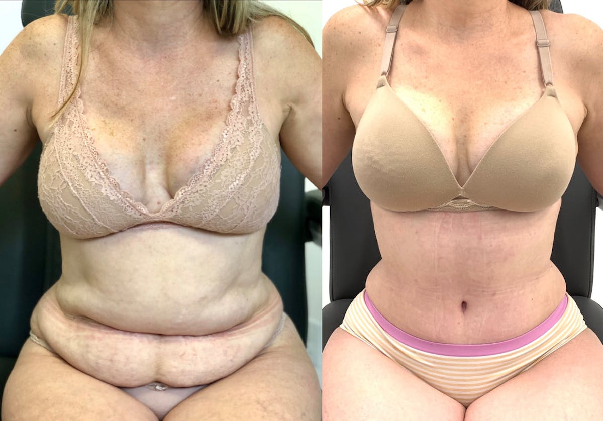 Tummy Tuck Before & After Gallery - Patient 314354 - Image 1