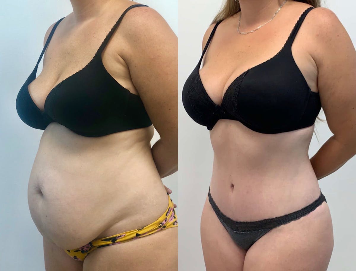 Tummy Tuck Before & After Gallery - Patient 149076 - Image 2