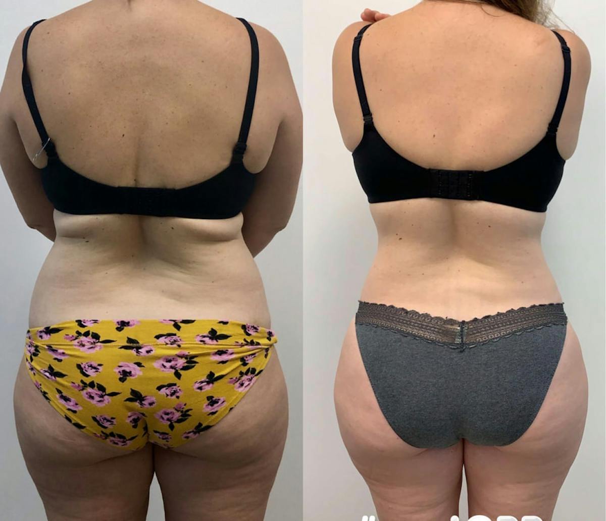 Tummy Tuck Before & After Gallery - Patient 149076 - Image 3
