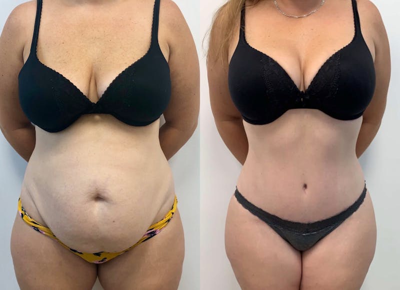 Tummy Tuck Before & After Gallery - Patient 149076 - Image 1