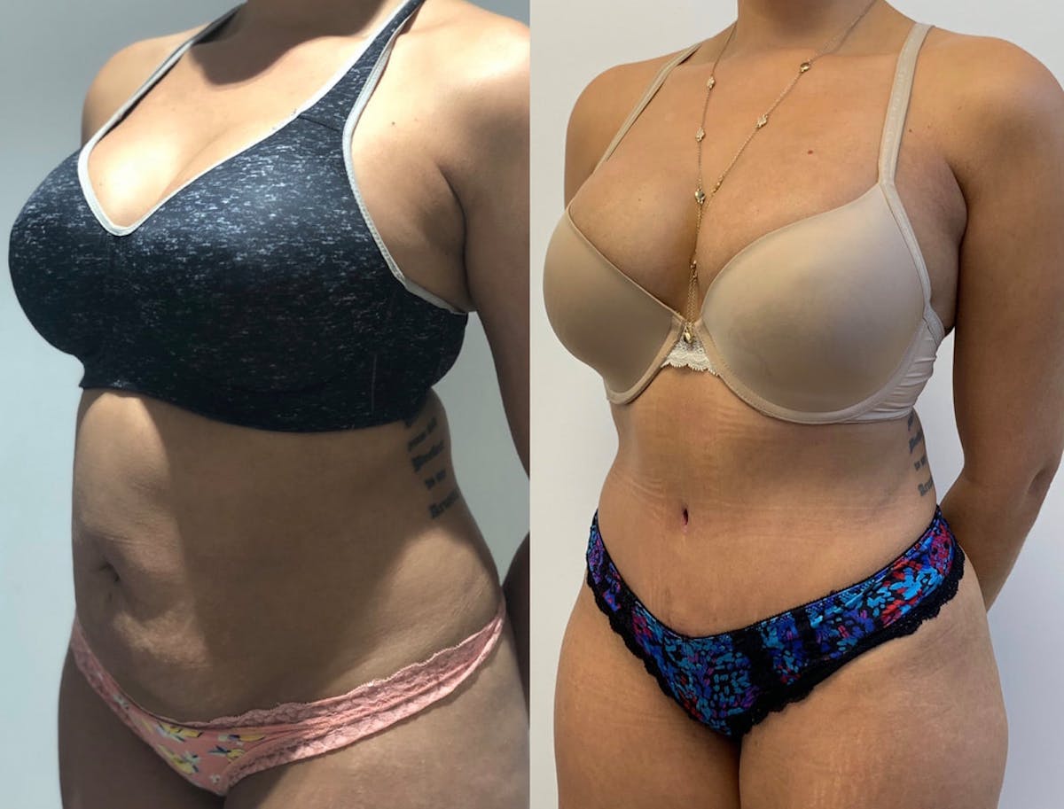 Tummy Tuck Before & After Gallery - Patient 210461 - Image 1