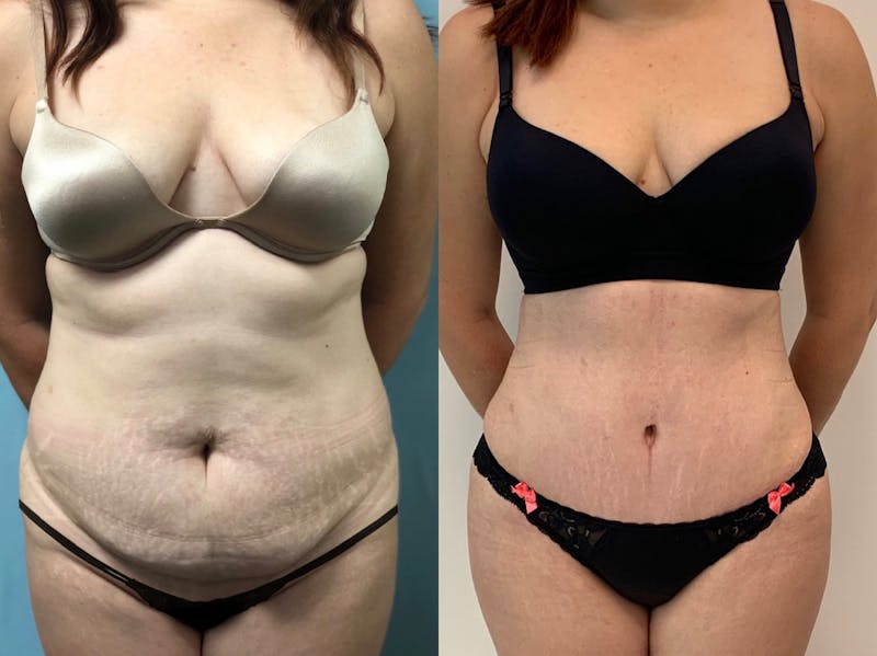 Tummy Tuck Before & After Gallery - Patient 382106 - Image 1