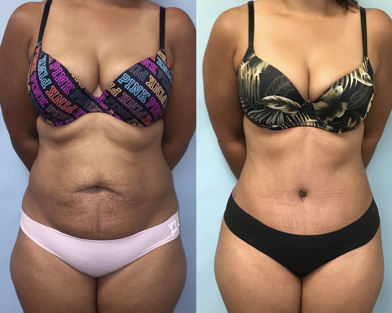 Tummy Tuck Before & After Gallery - Patient 747610 - Image 1