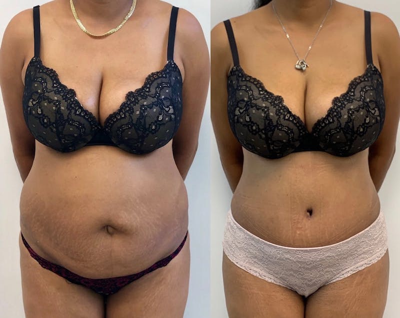 Tummy Tuck Before & After Gallery - Patient 145705 - Image 1