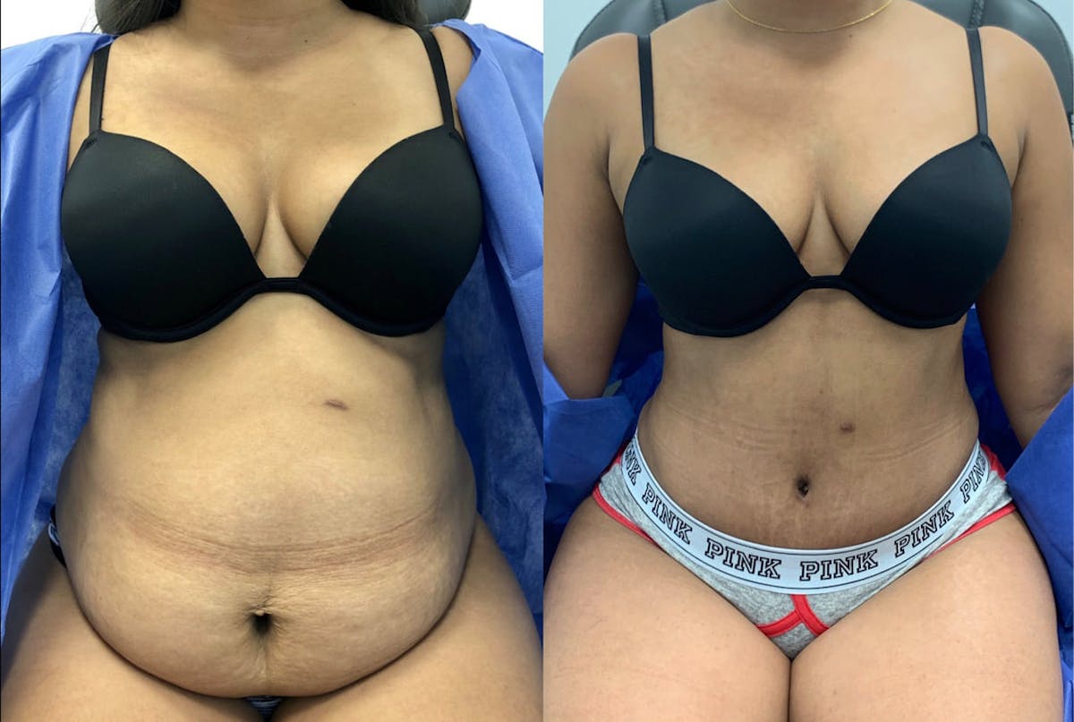 Tummy Tuck Before & After Gallery - Patient 368537 - Image 1